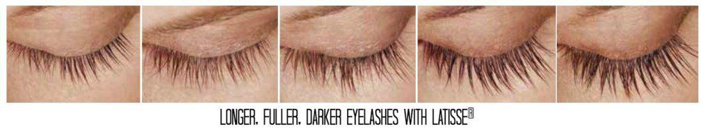 Longer, Fuller Eyelashes with LATISSE | South Ogden, UT | Timeless Med Spa