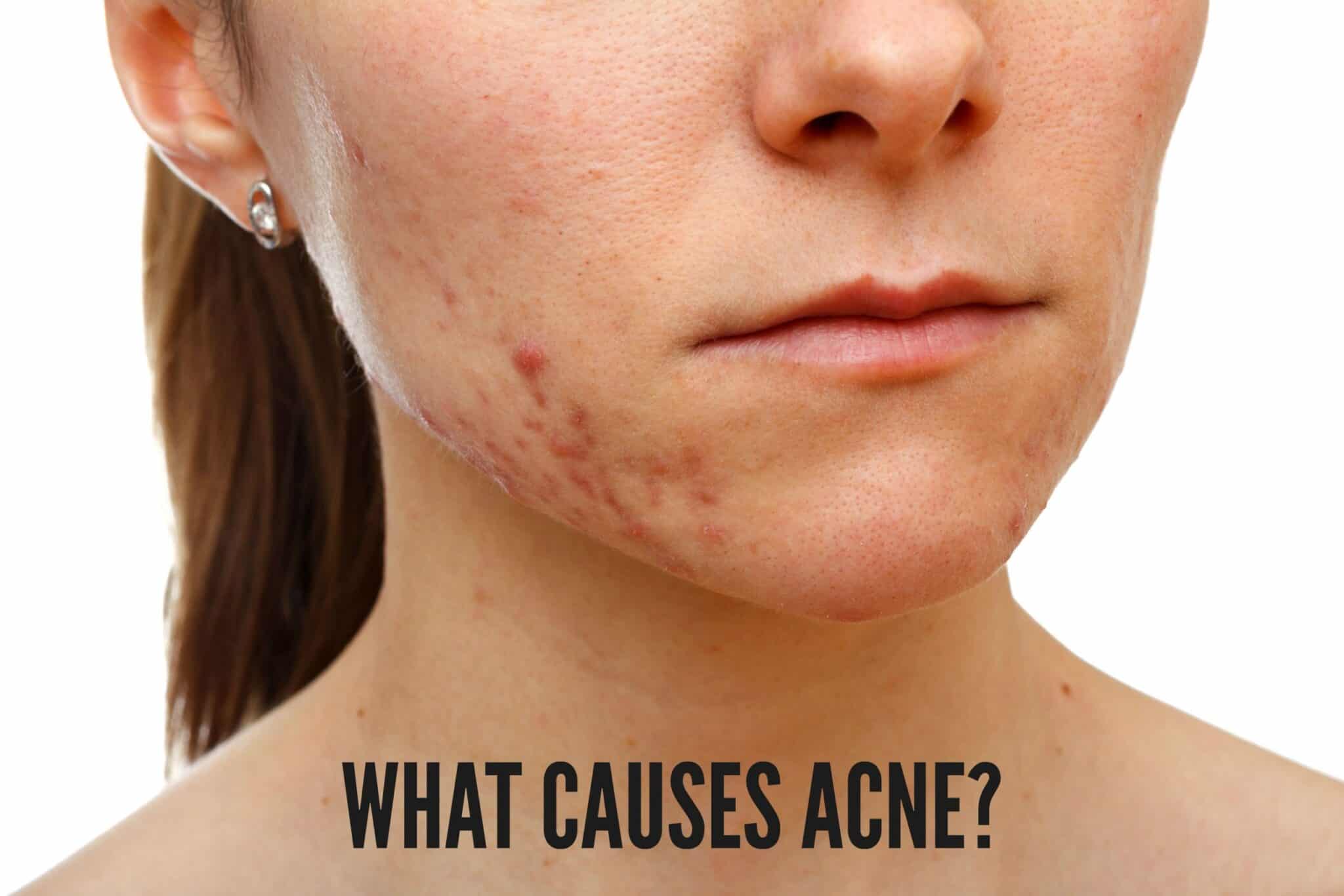 What Causes Acne? | South Ogden, UT | Timeless Med Spa
