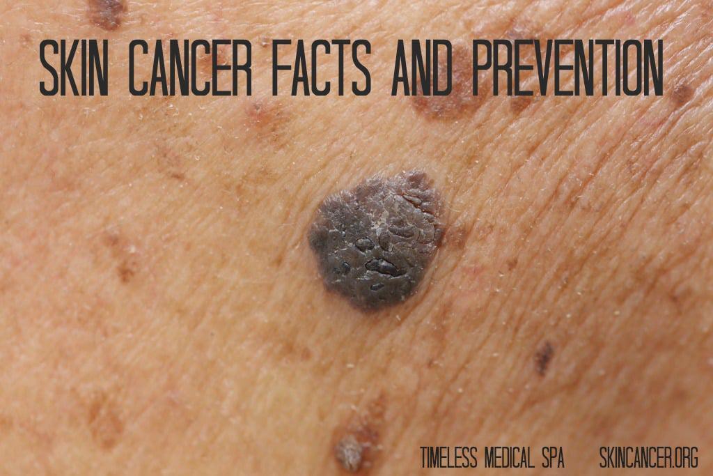 Skin Cancer Facts and Prevention | South Ogden, UT | Timeless Med Spa