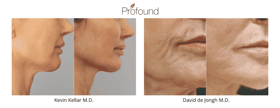Profound Before And After | South Ogden, UT | Timeless Med Spa