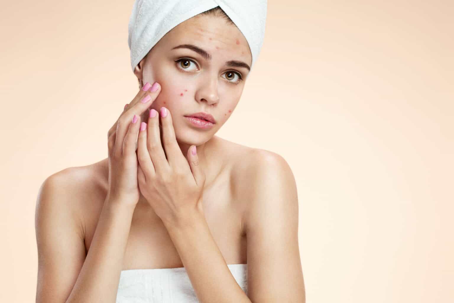 How To Get Rid Of Acne – Acne Treatments Near Me | South Ogden, UT | Timeless Med Spa