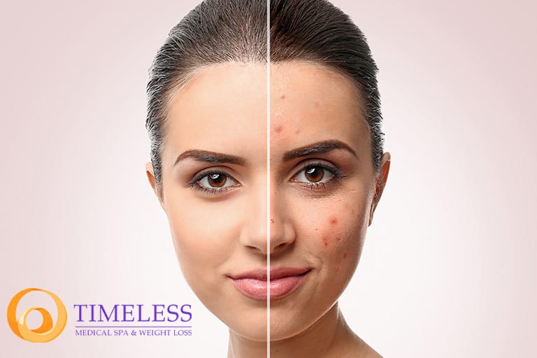 Causes and Treatment of Acne | South Ogden, UT | Timeless Med Spa